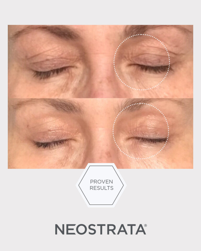 Bild till sociala medier NEOSTRATA Intensive Eye Therapy 7