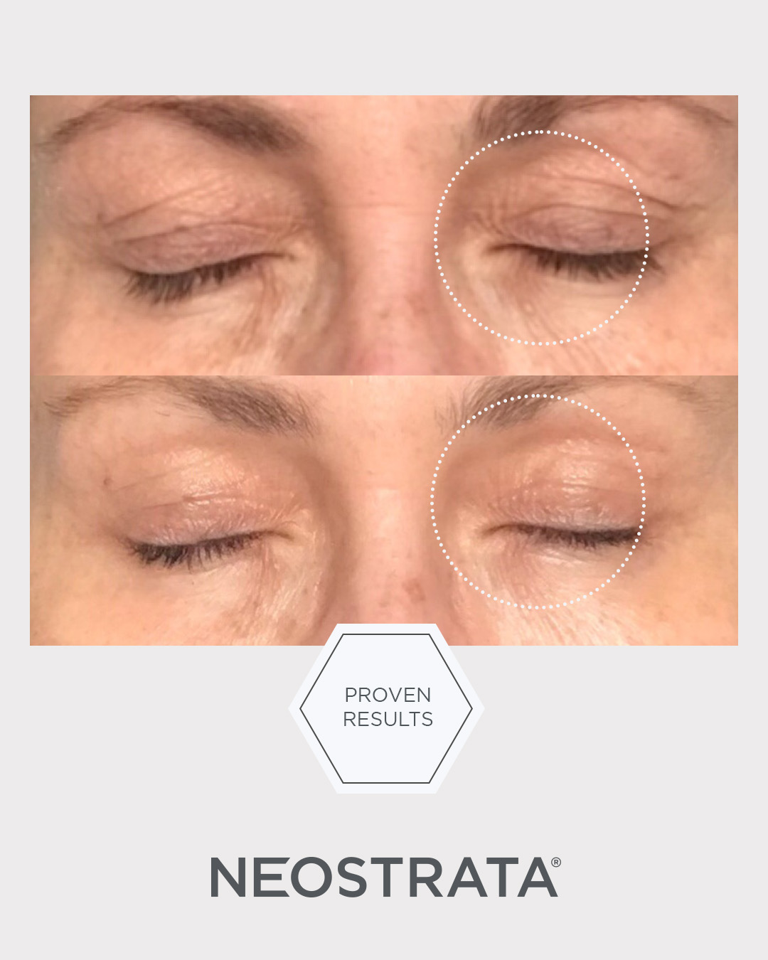 Bild till sociala medier NEOSTRATA Intensive Eye Therapy 7