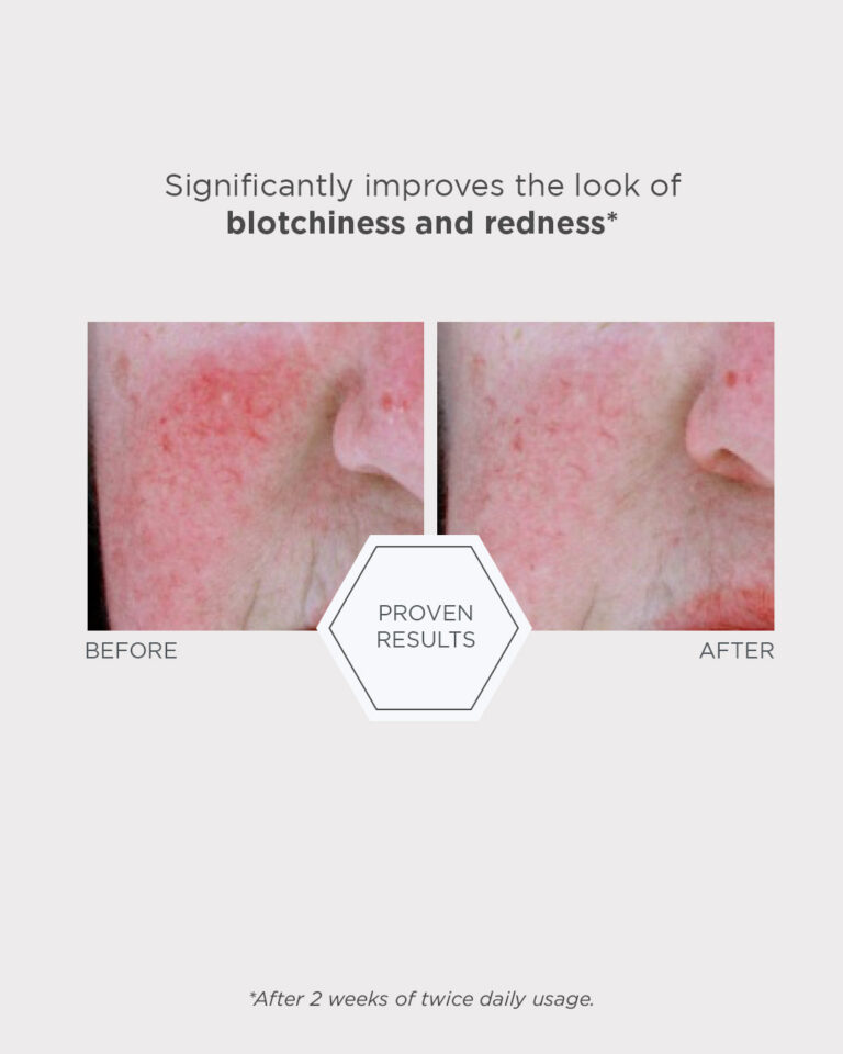 Bild till sociala medier NEOSTRATA Redness Neutralizing Serum 5