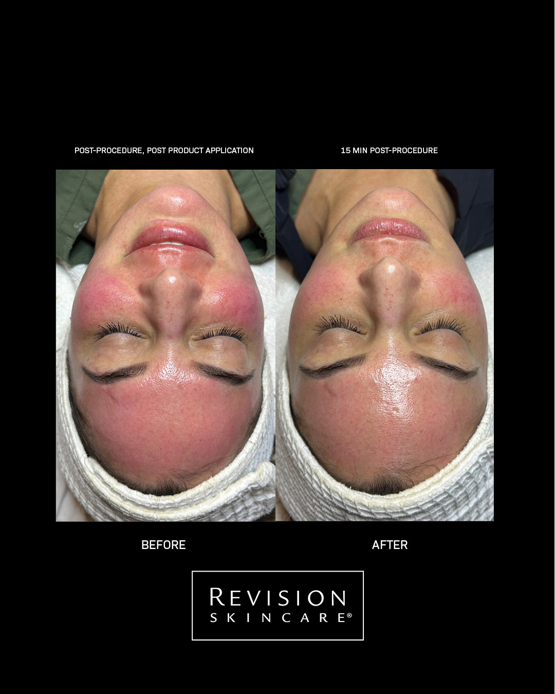 Bild till sociala medier Revision Skincare CMT results